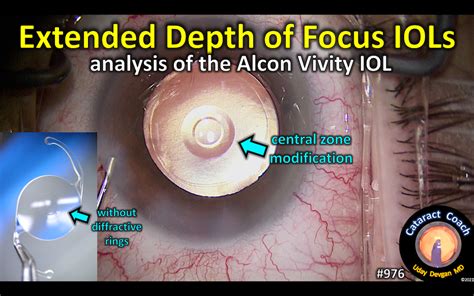 The Vivity lens is a non-diffractive extended depth of focus intraocular lens. . Tecnis symfony vs alcon vivity